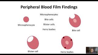 G6PD Deficiency