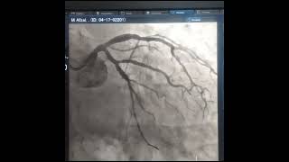 PCI To LCX N OM (Bifurcation)