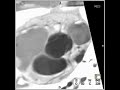 cardiac normal aortic valve 2 of 4