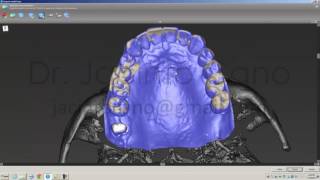 coDiagnostiX Full-Arch Stage Approach