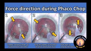 Learning the Force Directions during Phaco Chop Cataract Surgery