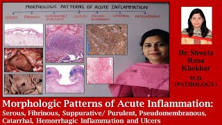 Morphologic Patterns of Acute Inflammation: Serous, Fibrinous, Suppurative Inflammation and Ulcers