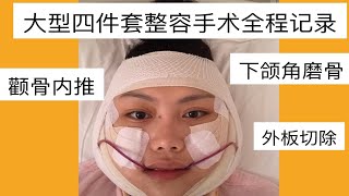 削骨磨骨轮廓四件套整容手术全程记录vlog | 我终于不是大饼脸了