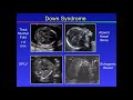 Fetal Congenital anomalies  part2