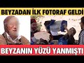 MASTERCHEF BEYZA YÜZÜ YANMIŞTI İLK FOTOGRAF GELDİ DOKTORUNDAN İLK AÇIKLAM YÜZÜNDEN AMELIYAT OLACAK