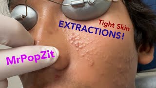 Tight skin acne extractions! Comedonal acne with some inflammatory nodules. Grea