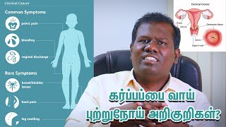 Symptoms of Uterine Cervix Cancer கர்ப்பப்பை வாய் புற்றுநோய் அறிகுறிகள்? Dr.Narendran