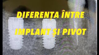 PIVOT si IMPLANT DENTAR. Care e diferenta?