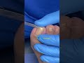 uñas encarnadas con fibromas