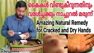 Amazing Natural Remedy for Cracked and Dry Hands, കൈകൾ വിണ്ടുകീറുന്നതിനും,വരൾച്ചക്കും പരിഹാരം