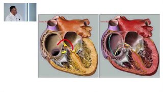 Taller Taquiarritmias Supraventriculares