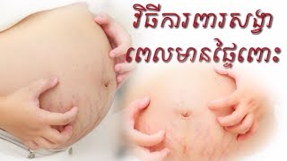 វិធីការពារសង្វាពេលមានផ្ទៃពោះ how to prevent stretch marks during pregnancy by Dr.Bun laysophea