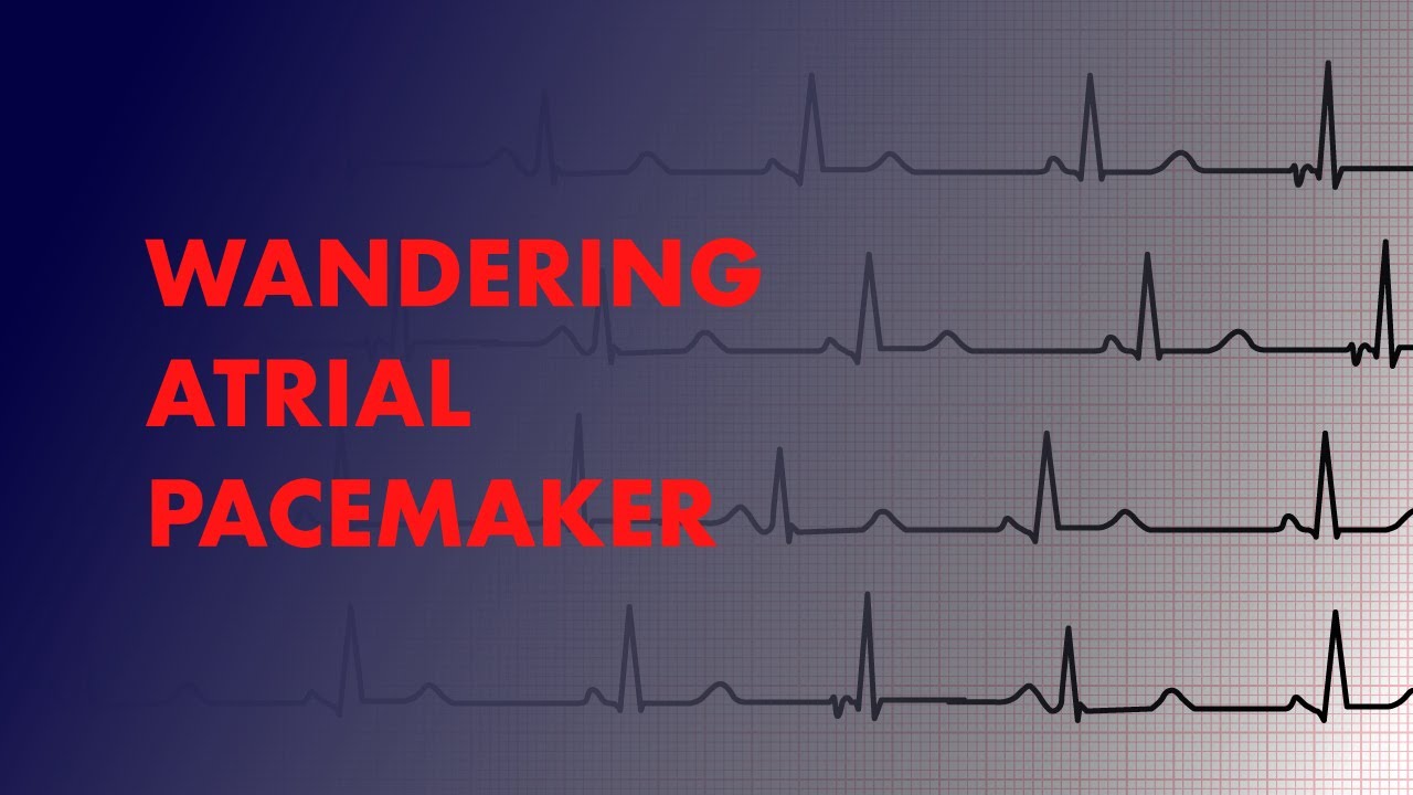 Wandering Atrial Pacemaker Rhythm Strip