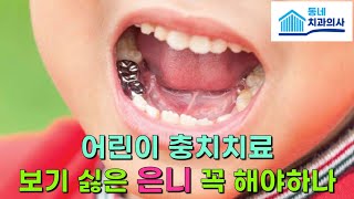 치아색 나는 레진이 있는데 은니를 꼭 해야 할까요?