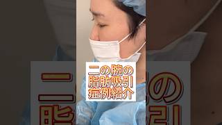 二の腕と肩を脂肪吸引して一回り細い腕にしてみた！