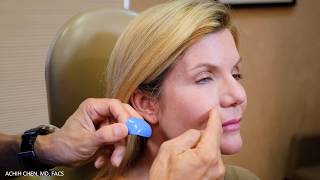 Mid-Face Rejuvenation | Mid-facelift Augusta | Plastic Surgeon Columbia SC