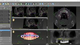 coDiagnostiX 10 Stackable Surgical Guide