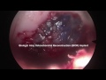 cartilage repair biologic inlay osteochondral reconstruction bior arthroscopic technique