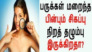 Tamil Health Care \u0026 Beauty Tips | பருக்கள் மறைந்த பின்பும் சிகப்பு நிறத் தழும்பு இருக்கிறதா?