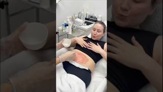 Stretch Mark Removal Test Pt 1