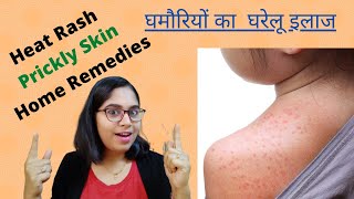 बेबी को घमोरी हो जाये तो क्या करे | घमोरिया का घरेलु उपाय| Heat rash, Prickly skin Prevention \u0026 Cure