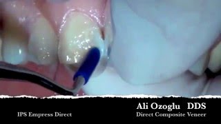 Direct Composite Veneer