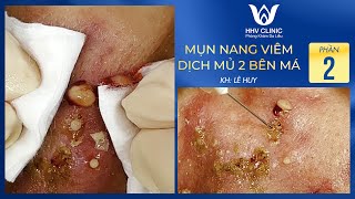 Mụn nang viêm - Dịch mủ 2 bên má - Phần 2 | HHV Clinic | Đỗ Thu Hiền | Hiền Vân Spa