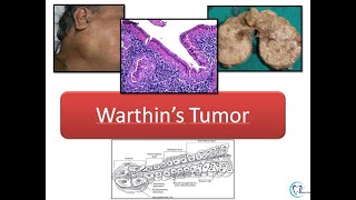 Warthin's tumor