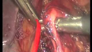 Laparoscopic Treatment of Median Arcuate Ligament Syndrome