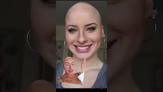 The way my face & hair changed each year #hairloss #alopecia #bald #alopeciaawareness #viral