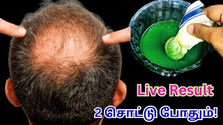 வெறும் 2 சொட்டு போதும் ஆயுசுக்கும் கவலை படவே மாட்டோம்!! 100% effective hair remedy