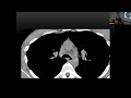 2024 october grand rounds “imaging appearances of large airway disease”