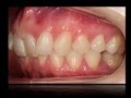 Invisalign Tratamiento de una maloclusión dental Clase II div 2º.