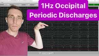 EEG with 1Hz Occipital Periodic Discharges