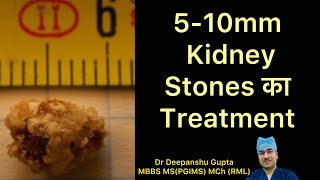 5-10mm Kidney Stone का इलाज कैसे होता है?? Treatment for 5-10 mm Kidney stones (In Hindi)