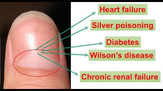 BIOLOGY BEHIND HALF-MOON SHAPE ON OUR FINGERNAILS|| WHITE/BLACK/YELLOW SPOT ON NAIL|| LUNULAE?