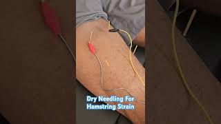 Dry needling for hamstring strain #dryneedling #physicaltherapy #fuelyourlife