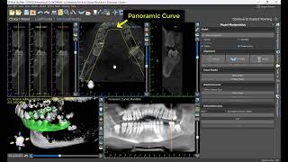 Part 2 : Mastering Advanced Mode in Blue Sky Plan - Immediate Implant Planning