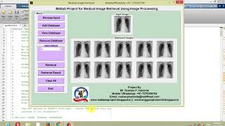 Medical Image Retrieval Using Matlab