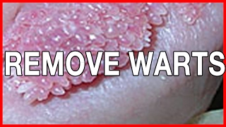 Genital Wart Removal for Women: Information, pictures and methods