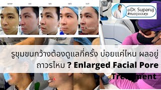 รูขุมขนกว้างต้องดูแลกี่ครั้ง บ่อยแค่ไหน ผลอยู่ถาวรไหม ? Enlarged Facial Pore Treatment