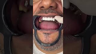 ابتسامة هوليوود / Hollywood smile / gülüş tasarımı