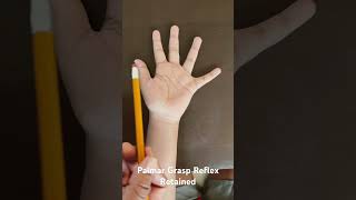 Primitive Reflexes- Palmar Grasp Reflex Retained