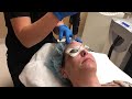 procedure picosure laser facial