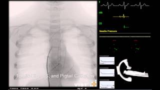 Mentice - Transseptal Puncture