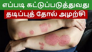 தடிப்புத் தோல் அழற்சியை எவ்வாறு கட்டுப்படுத்துவது | Tips to Control Psoriasis | Dr. Megha Chaturvedi