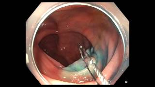 Serrated Polyps of the Colon: Ensuring Complete Removal