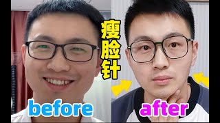 【皮肤科医生亲测】瘦脸针效果真的明显吗？什么样的人不适合？