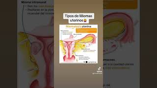 Tipos de miomas o fibromas uterinos #ginecologia #miomas #miomasuterinos #fibromauterino #miomatosis