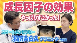 【成長因子でAGA治療】スマートメソセラピーの効果はやっぱりすごかった！